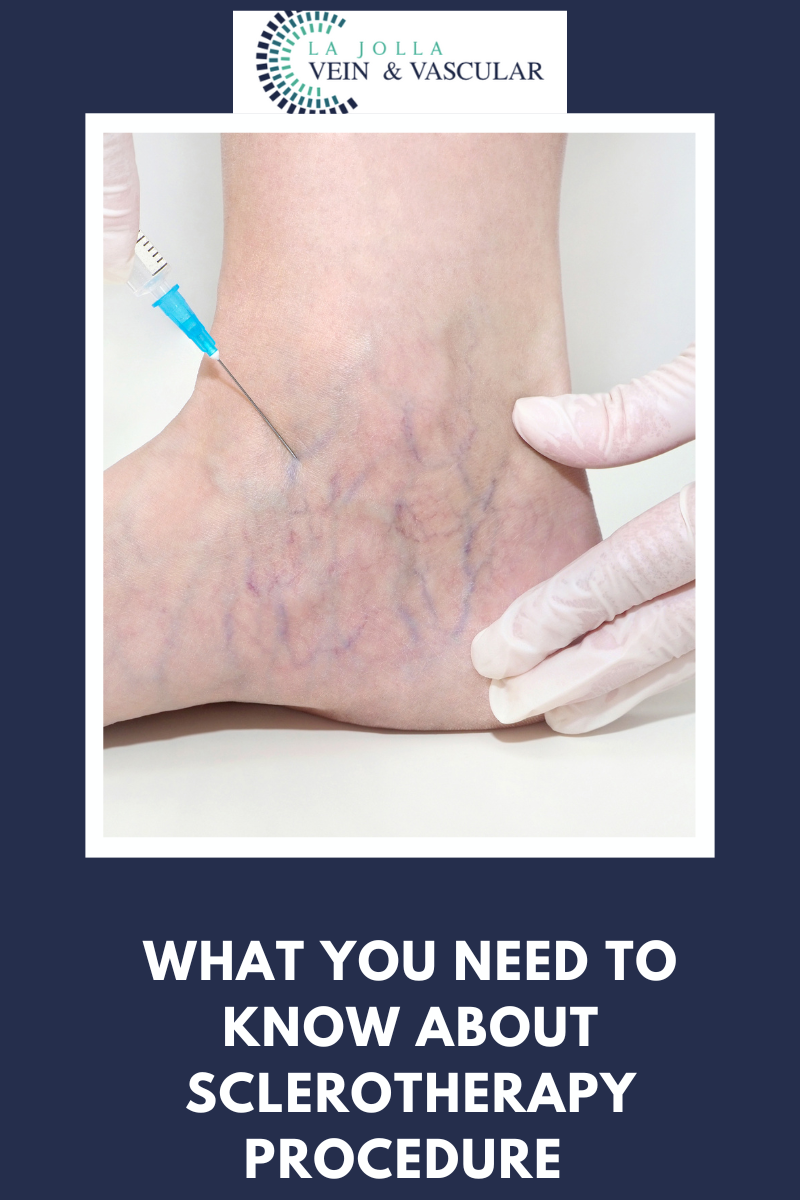 14 sclerotherapy