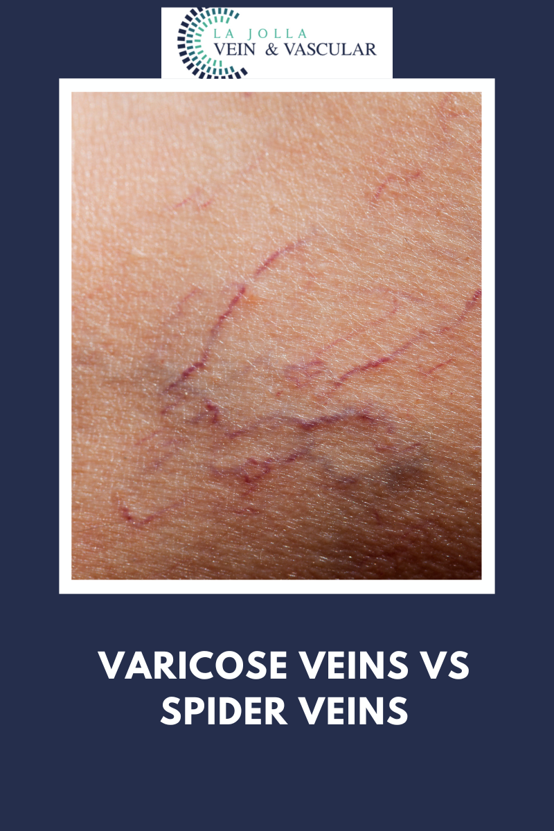 spider veins