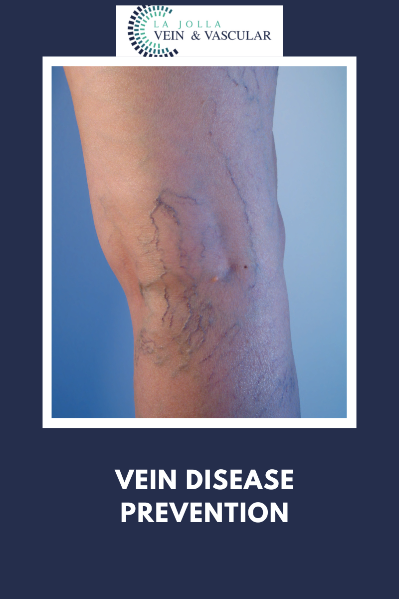 vein disease