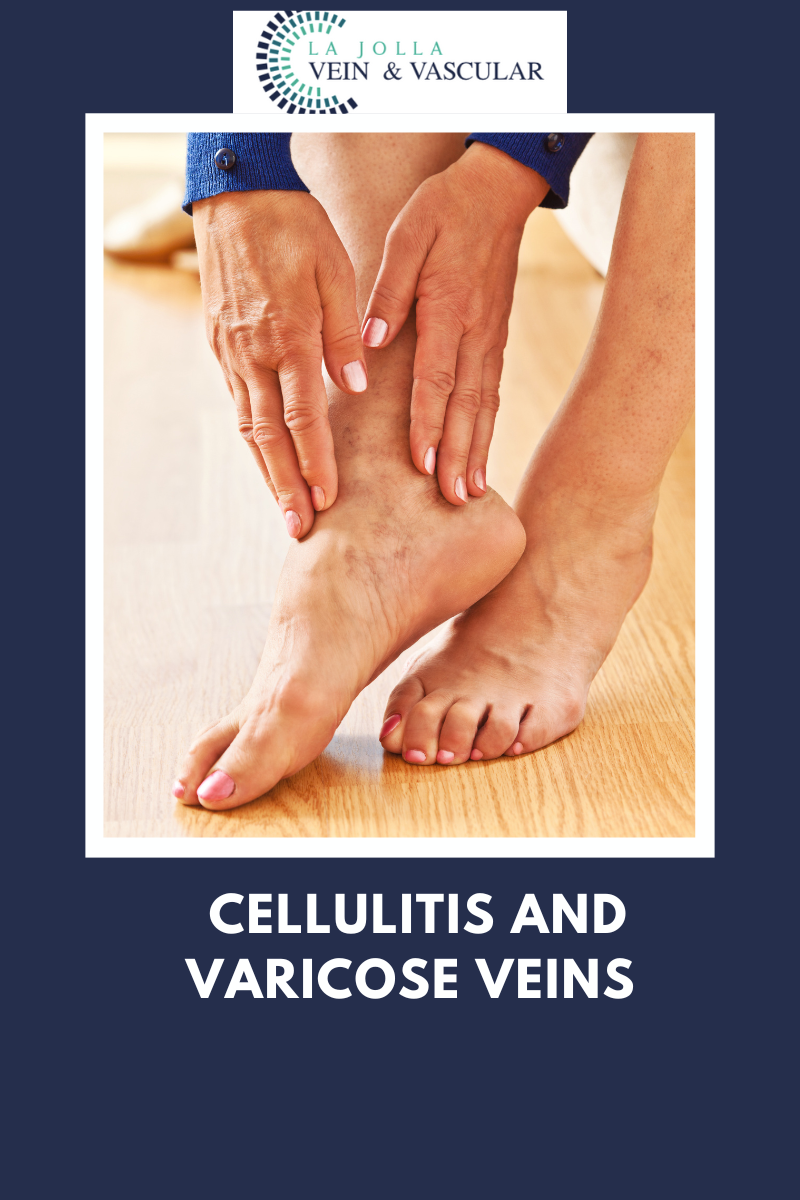cellulitis