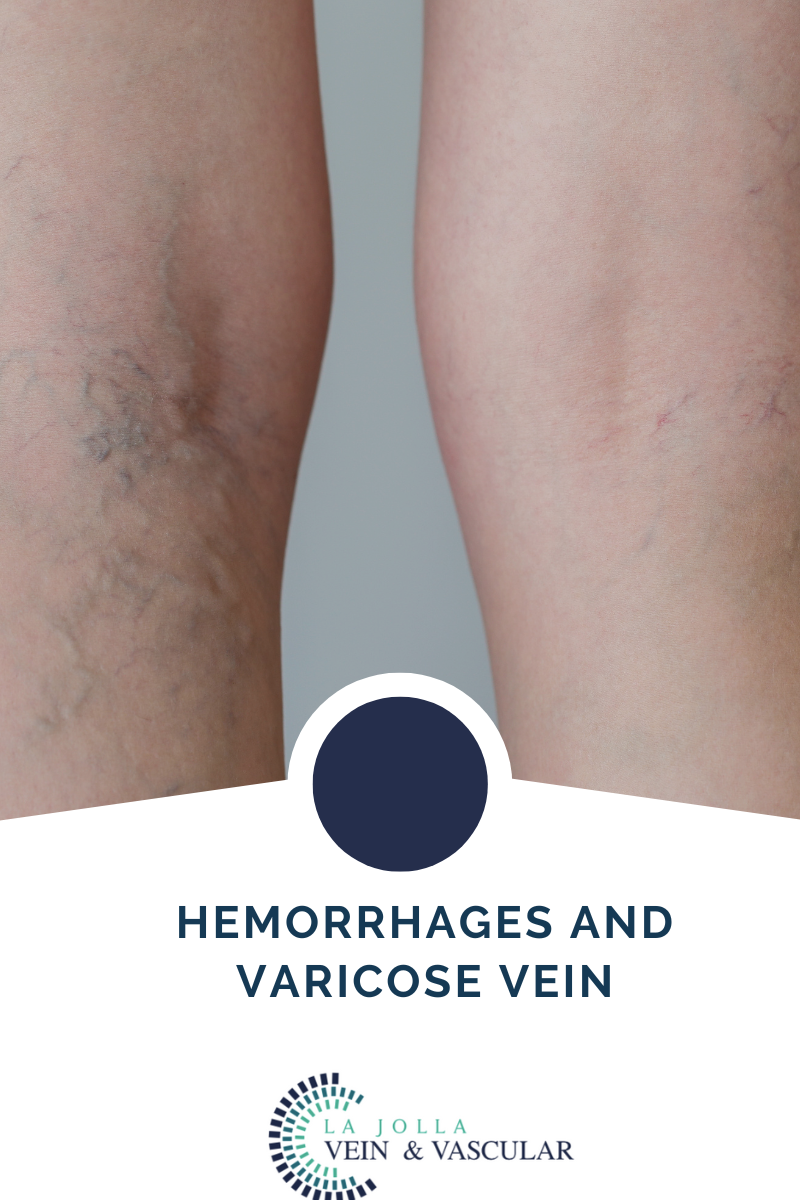 4 hemorrhage