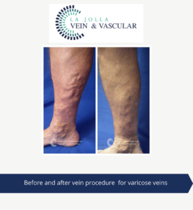 varicose veins