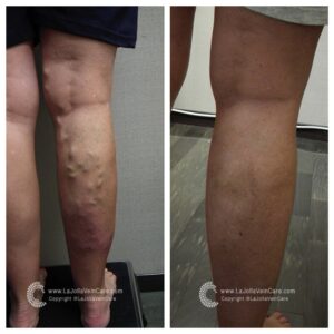 varicose vein