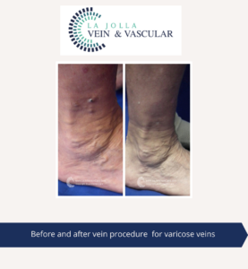 varicose veins