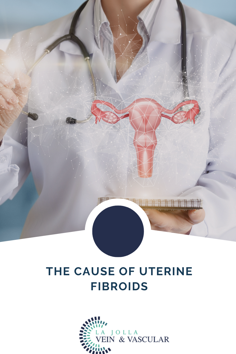 15155 fibroids