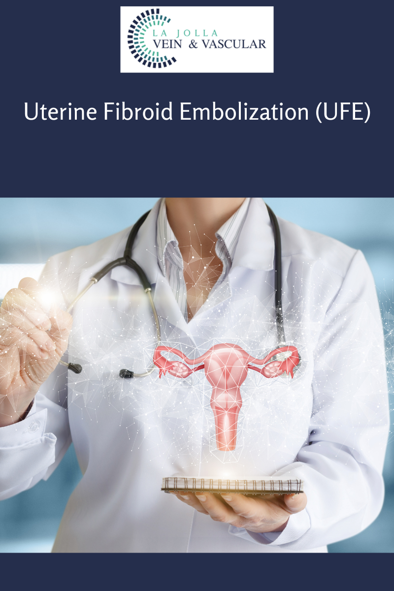 Uterine Fibroid Embolization (UFE) Uterine Fibroid Embolization