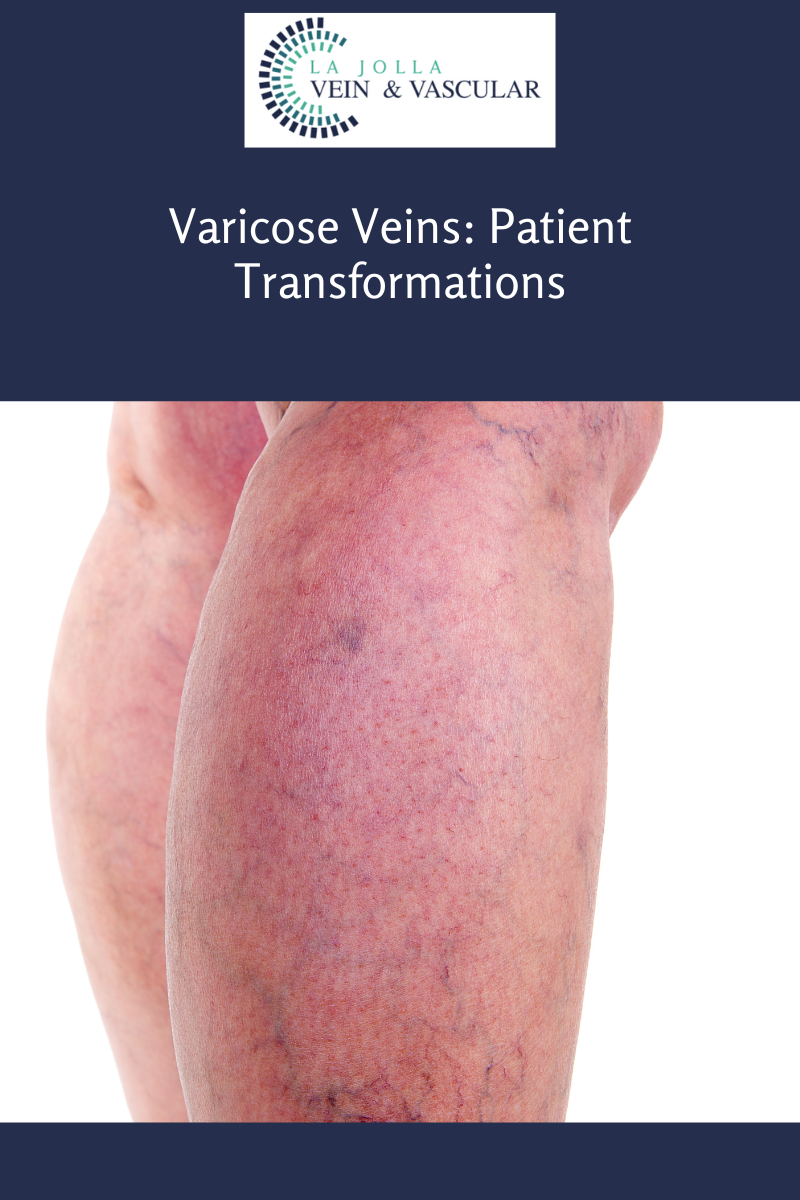 varicose