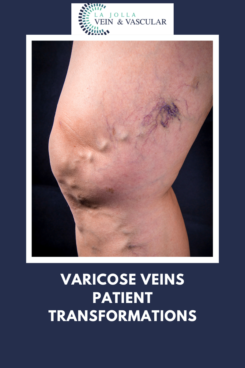 Varicose Veins Patient Transformations varicose