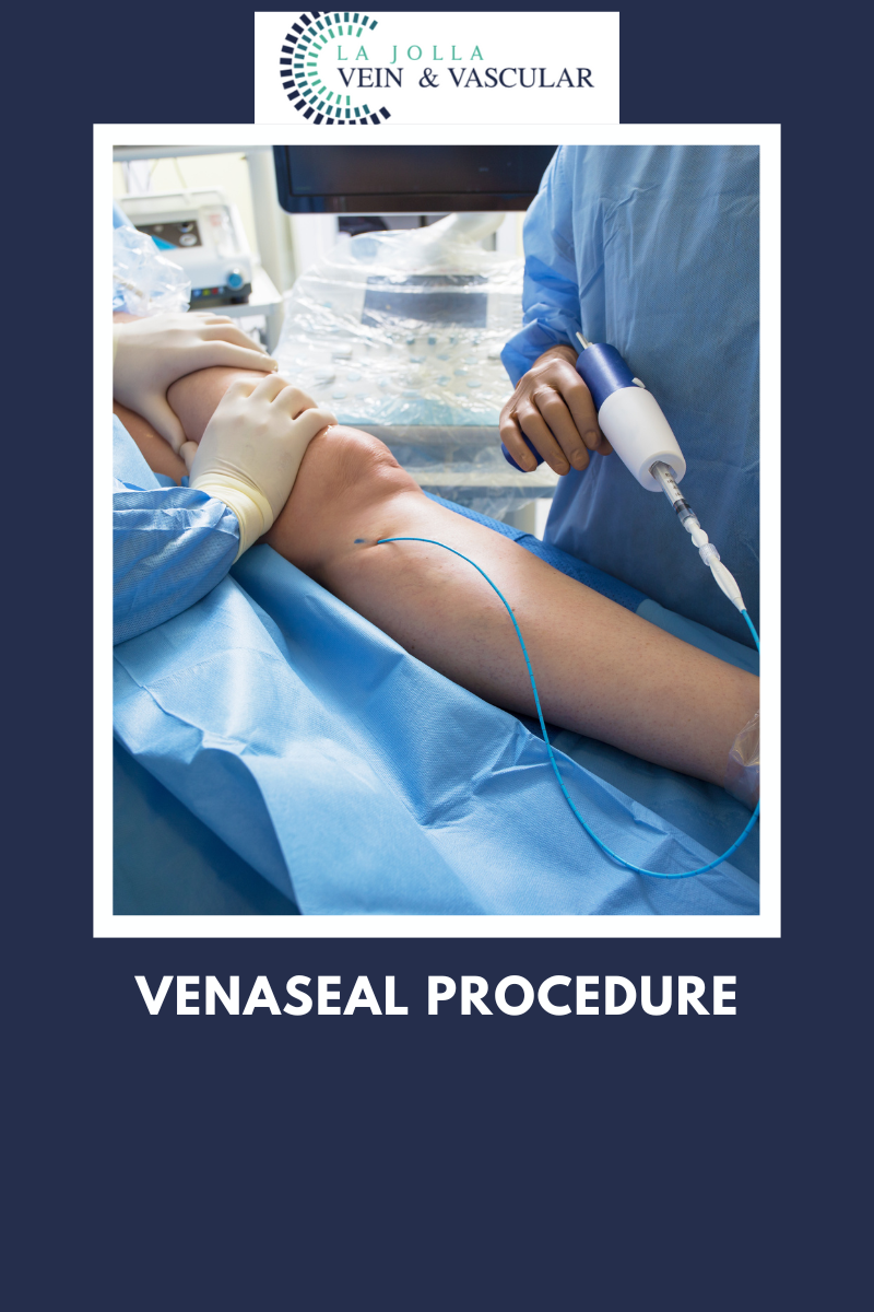 VenaSeal Procedure venaseal