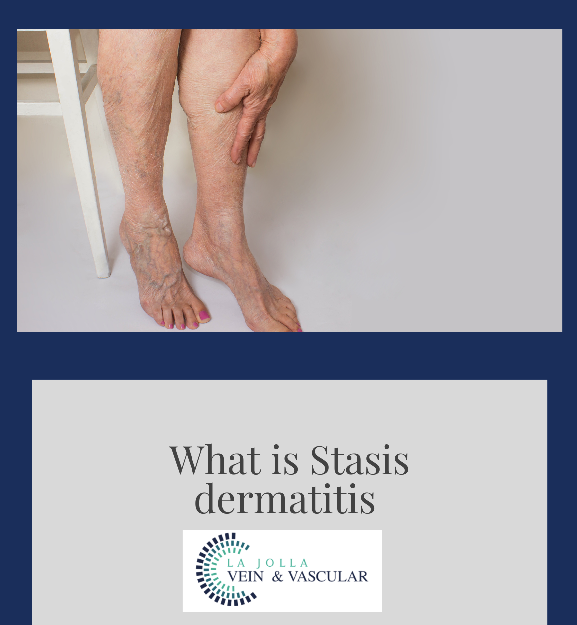 What is Stasis dermatitis stasis