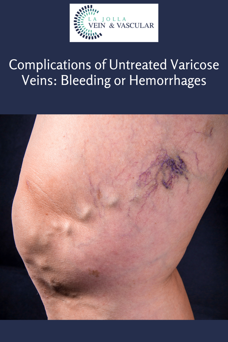 complicationsofuntreatedvaricoseveins varicose veins