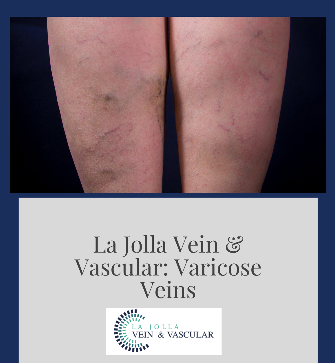 varicose veins