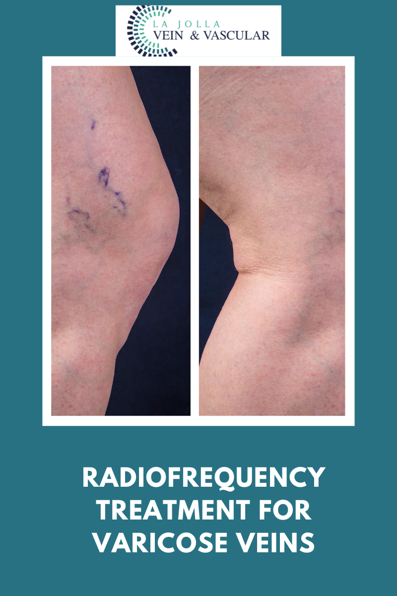 radiofrequency