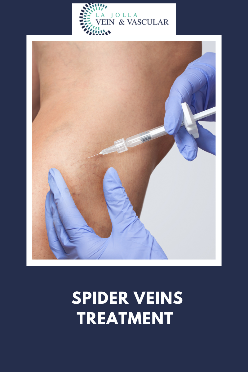 spider veins