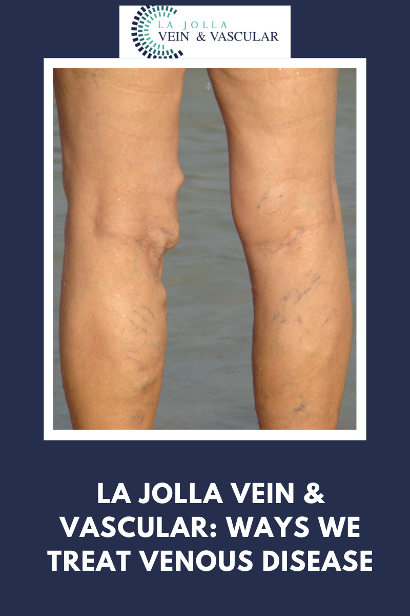 vein