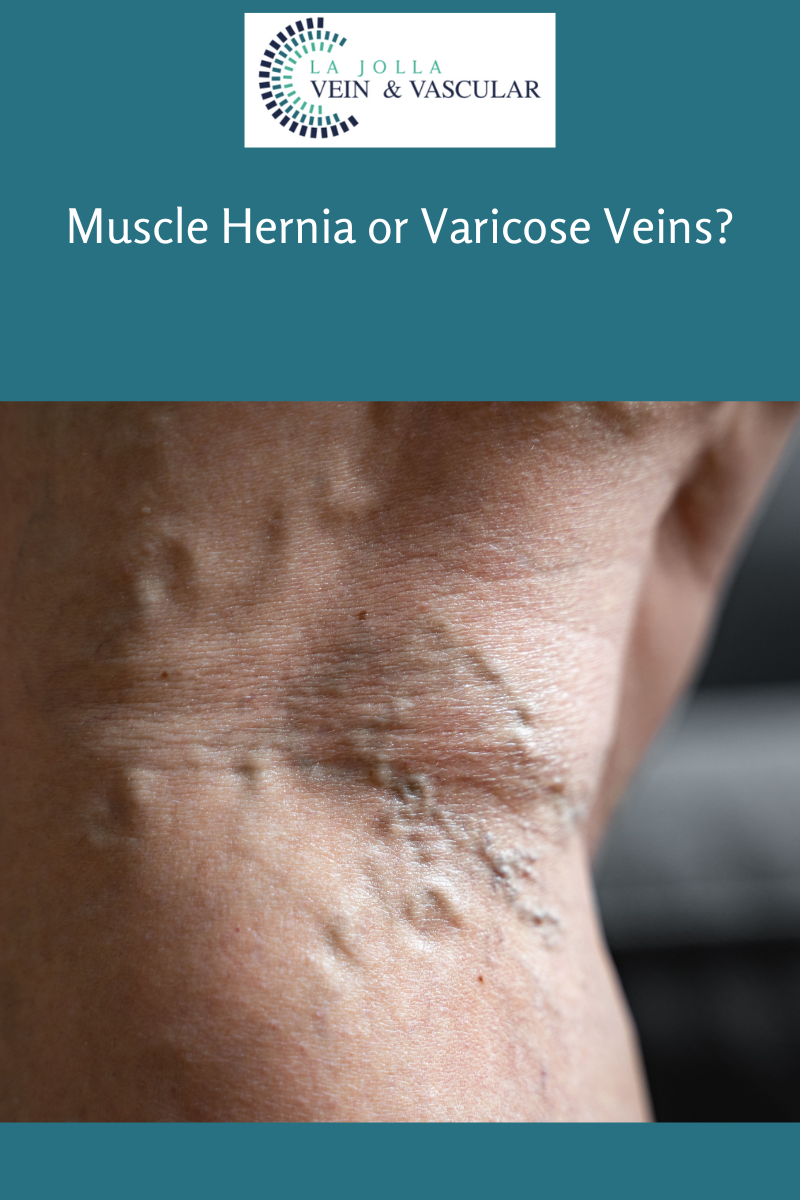 Bunke Blogs New 3-19 hernia