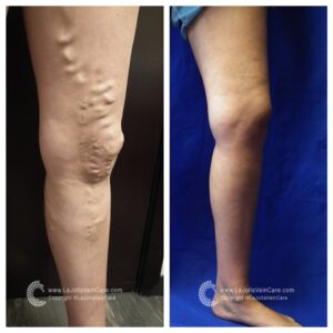 venous