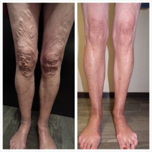 venous