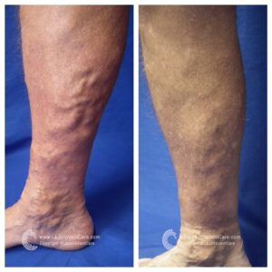 venous