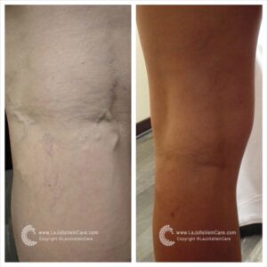 venous