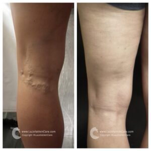 venous
