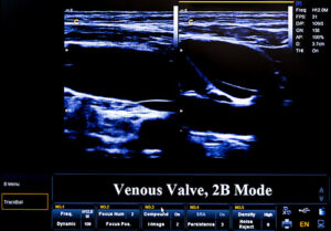 Vein & vascular conditions are not always visible to the naked eye 24 vein