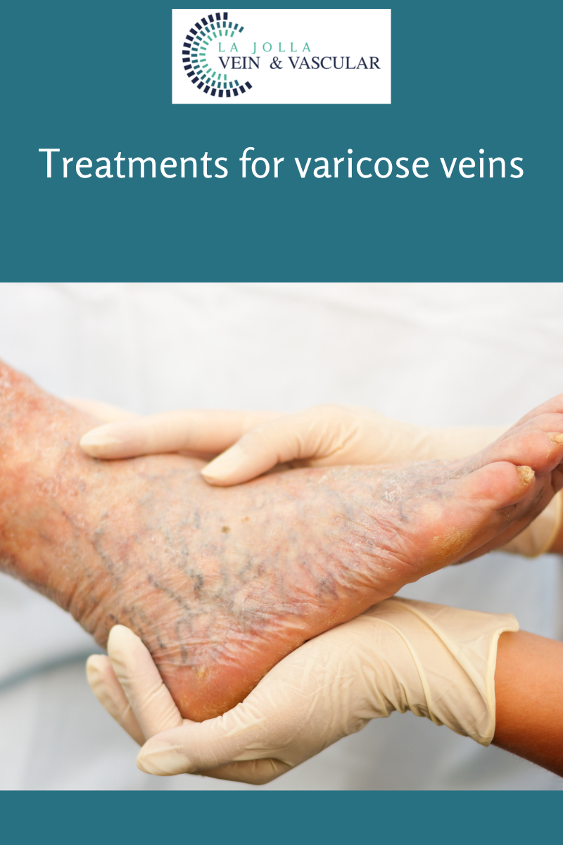 varicose