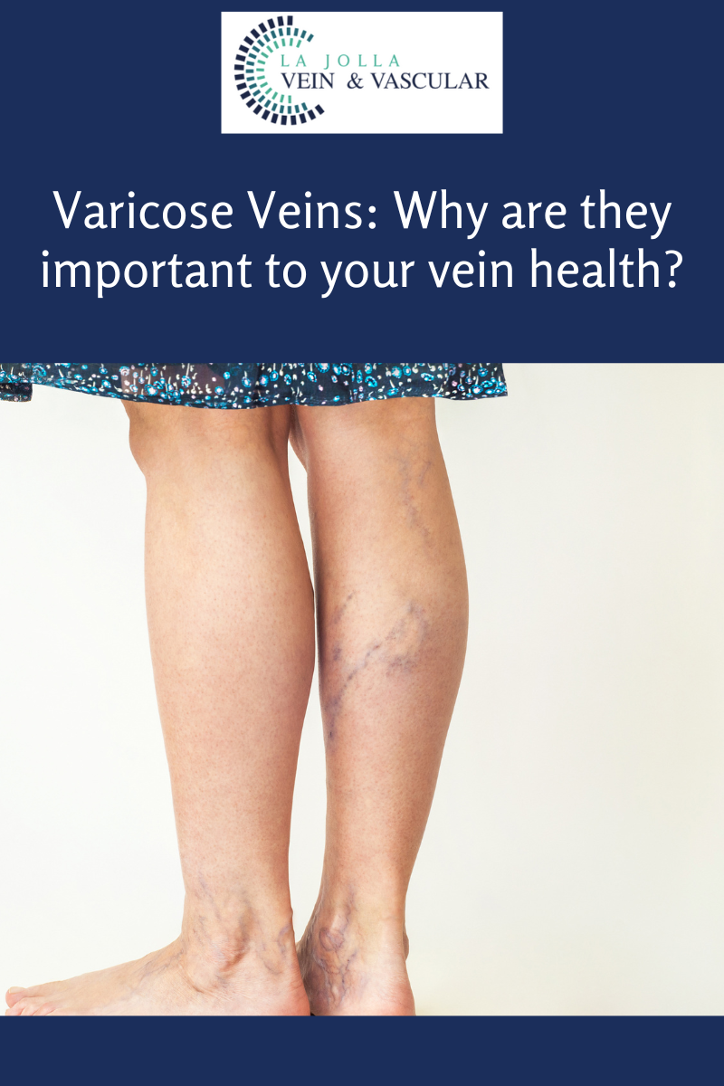 30 varicose veins