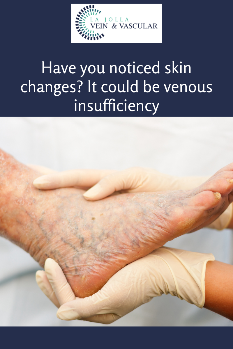 33 venous insufficiency
