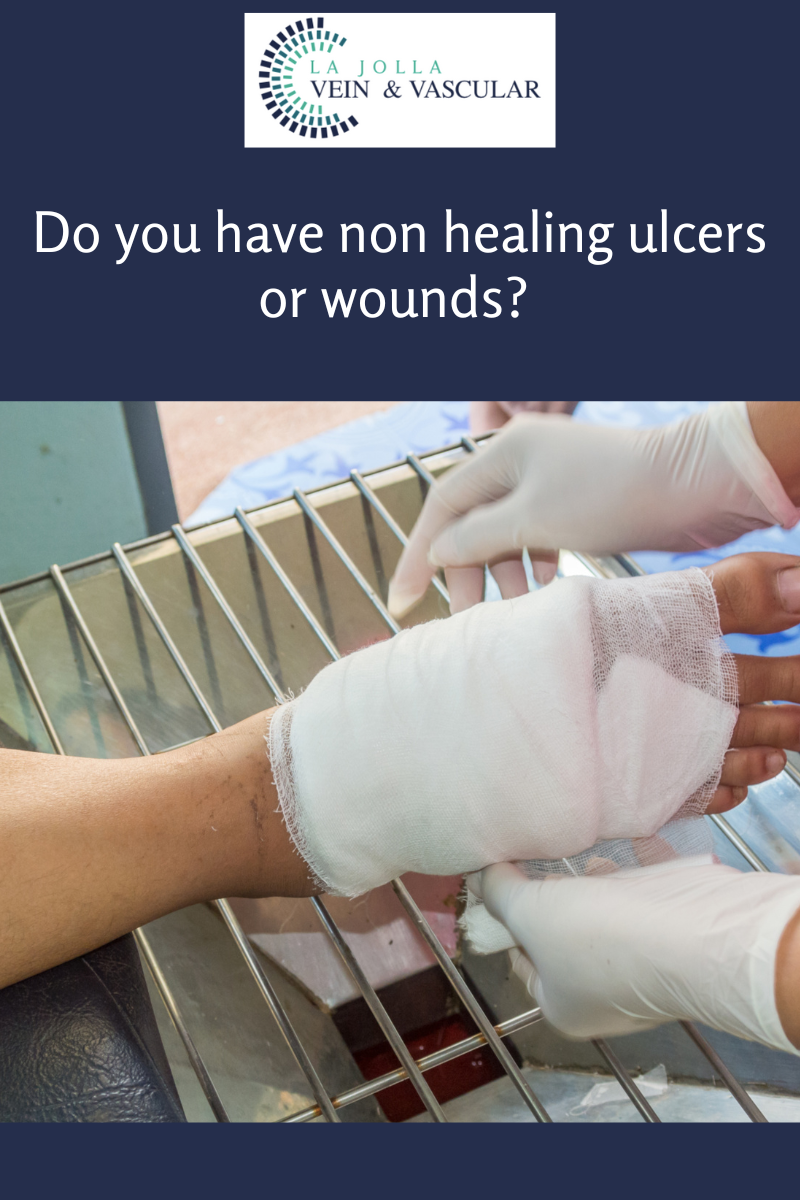 39 ulcers