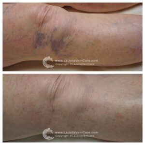 spider veins