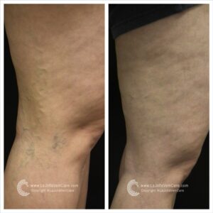 varicose veins