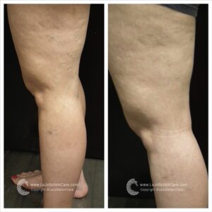 varicose veins