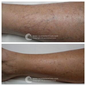 spider veins