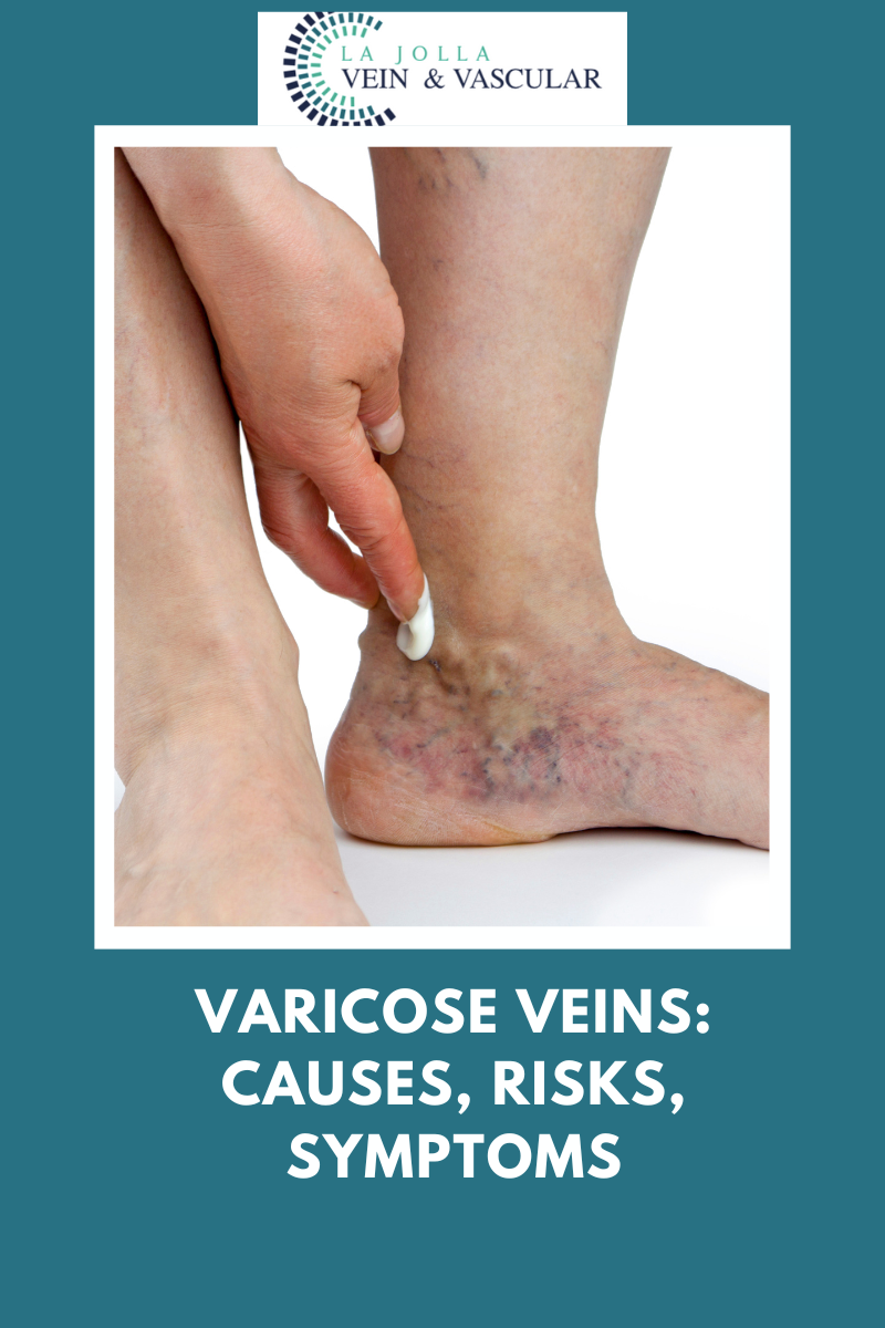 7 varicose