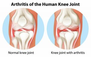 knee