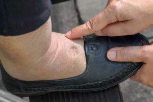 swelling