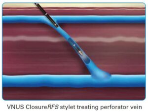 Perforator