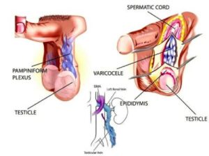 varicocele