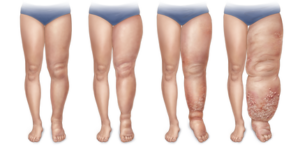 swelling