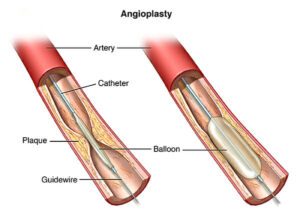 arterial