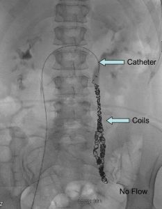 pelvic