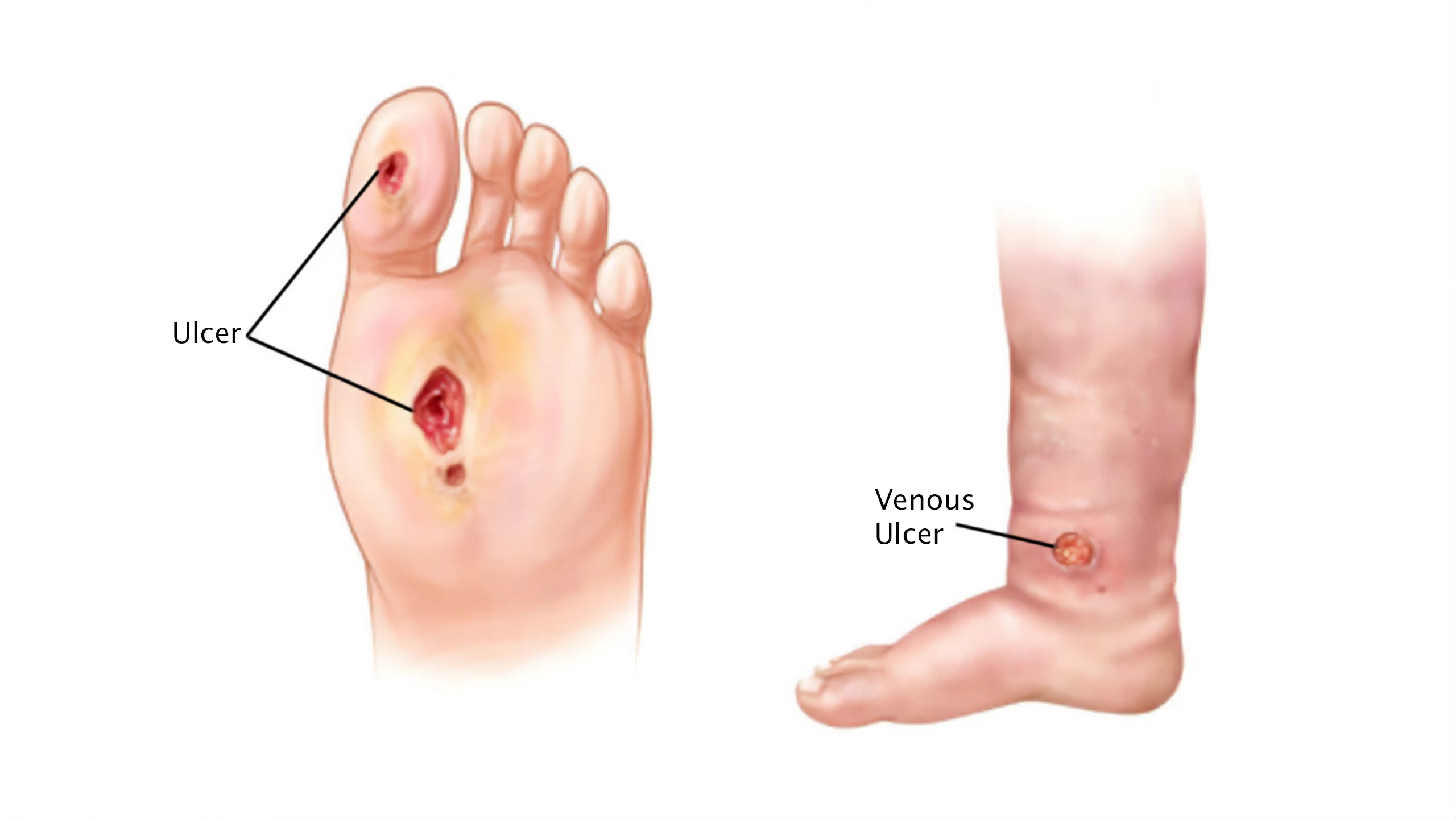 Non-Healing Wounds or Ulcers - Symptoms, Causes & Treatment