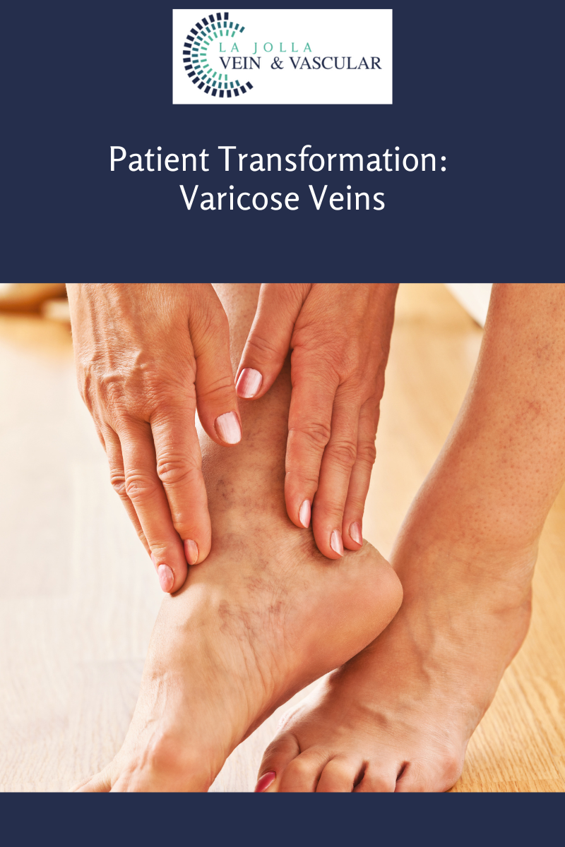 11 varicose vein treatment