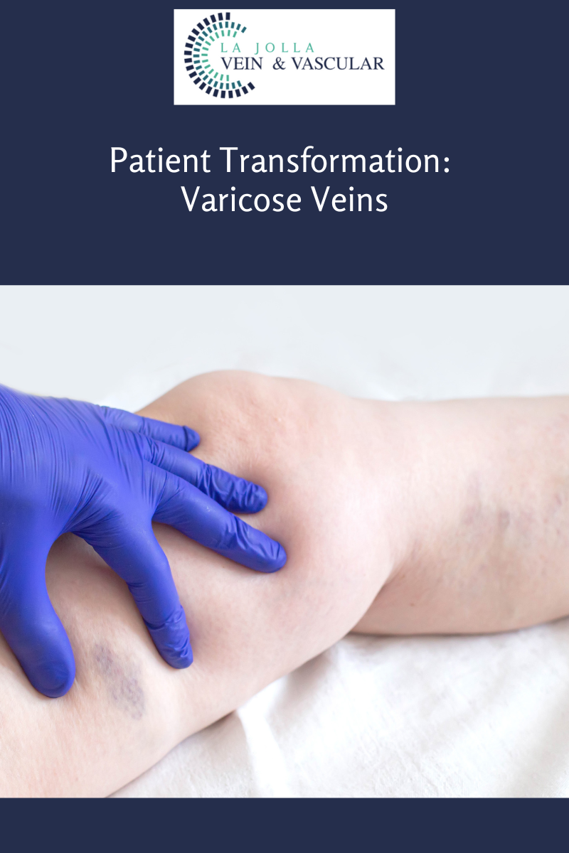 varicose vein treatment