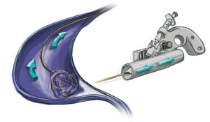 mechanical chemical ablation