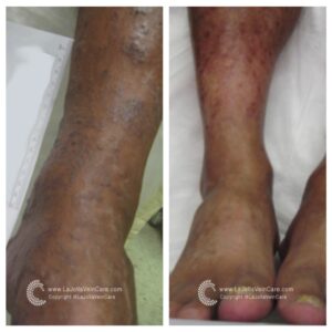 Spider vein treatment
