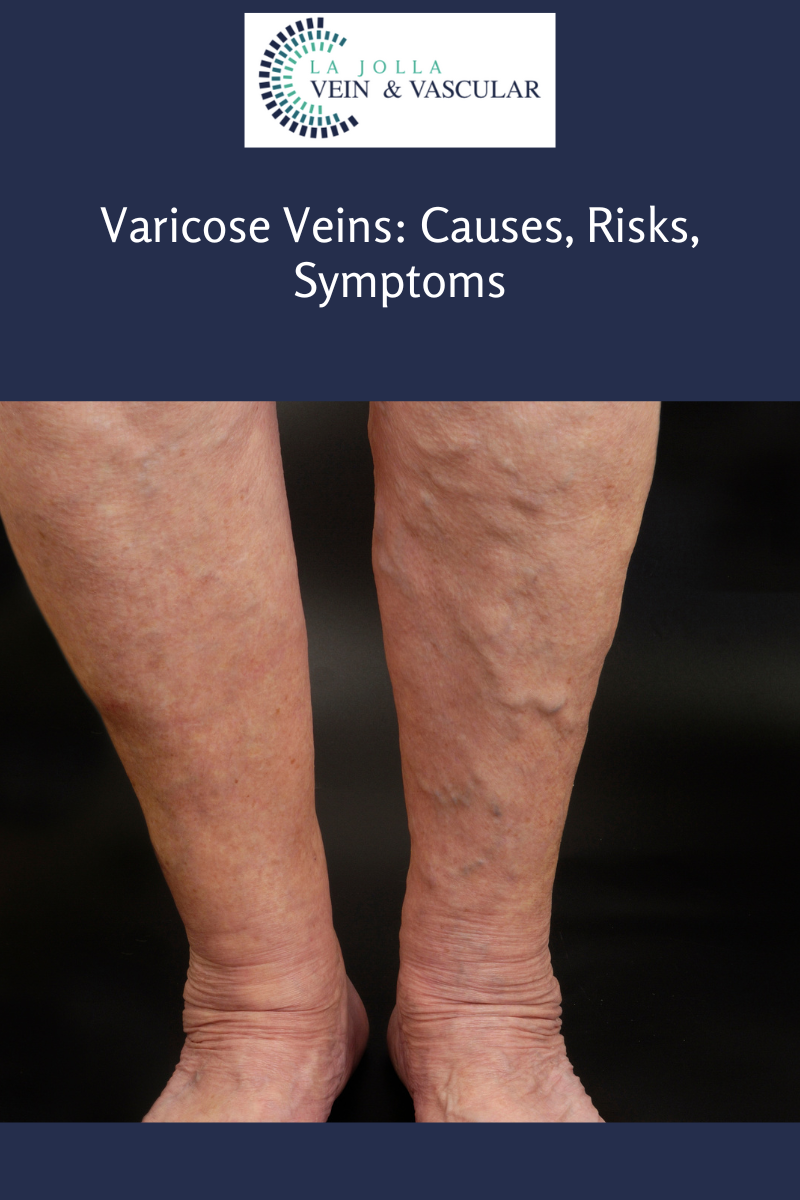 varicose veins