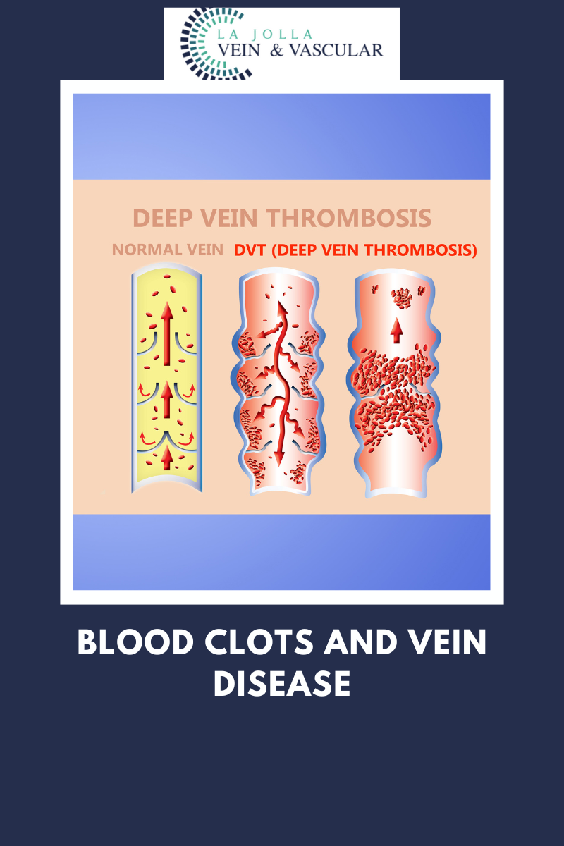 blood clot