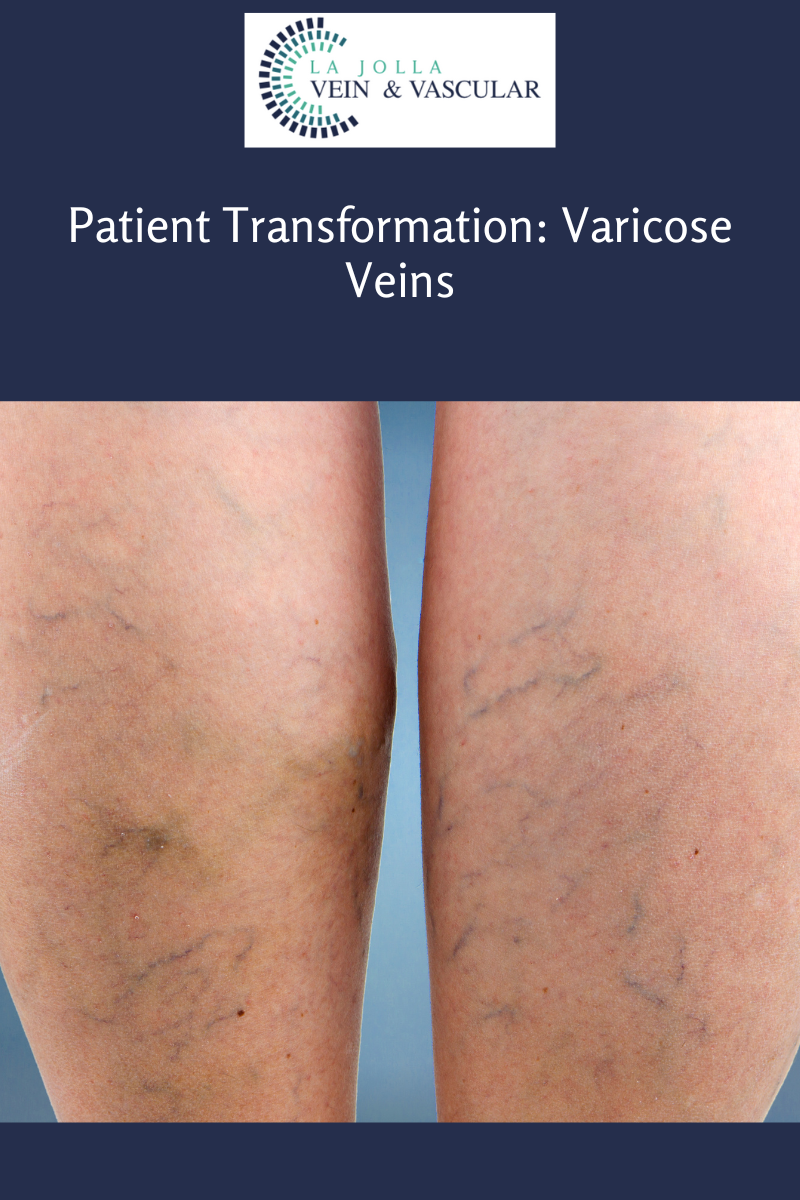varicose vein treatment
